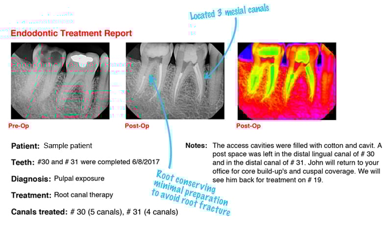 Patient X-ray report for Pulpal Exposure 