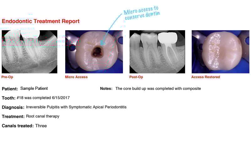 Patient X-ray report for Irreversible Pulpitis with Symptomatic Apical Periodontitis
