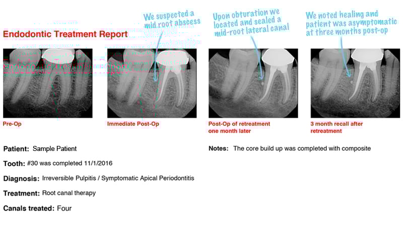 Patient X-ray report for Irreversible Pulpitis / Symptomatic Apical Periodontitis