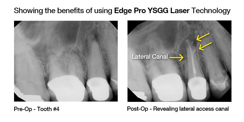 Before and after using Edge Pro YSGG Laser 